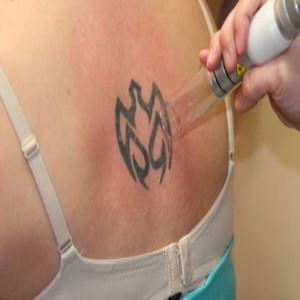 rimozione laser tatuaggio