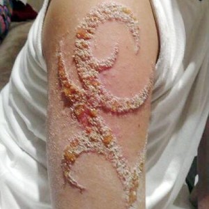 infezione tattoo in casa