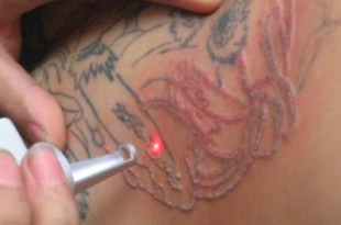 laser tattoo