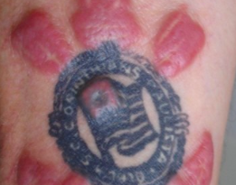 tatuaggio allergia