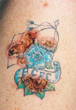 Reazione allergica sulla pelle: minaccia il tattoo?