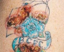 allergia-tatuaggi-pigmenti