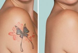 laser cover up tattoo